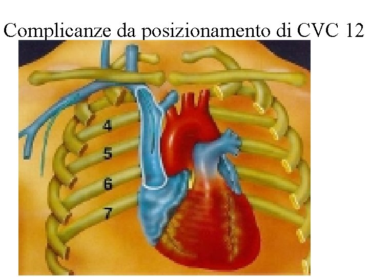 Complicanze da posizionamento di CVC 12 
