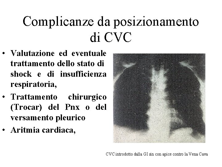 Complicanze da posizionamento di CVC • Valutazione ed eventuale trattamento dello stato di shock