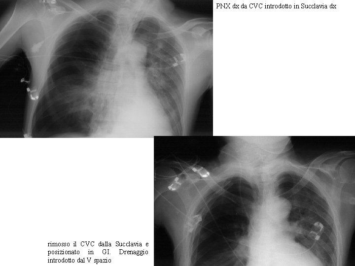 PNX dx da CVC introdotto in Succlavia dx rimosso il CVC dalla Succlavia e