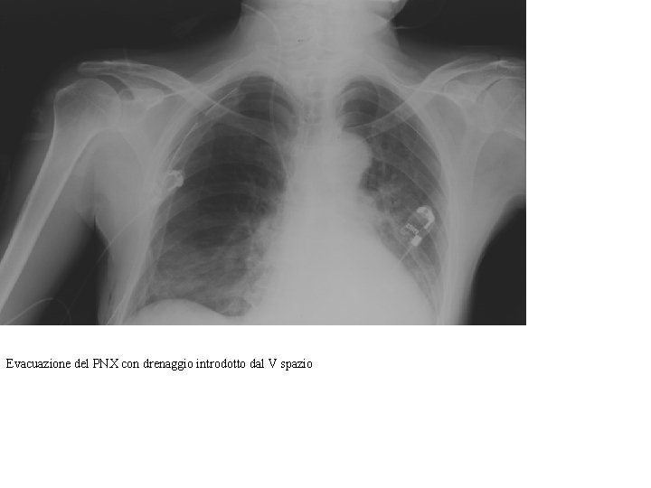 Evacuazione del PNX con drenaggio introdotto dal V spazio 