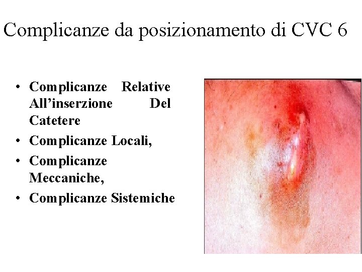 Complicanze da posizionamento di CVC 6 • Complicanze Relative All’inserzione Del Catetere • Complicanze