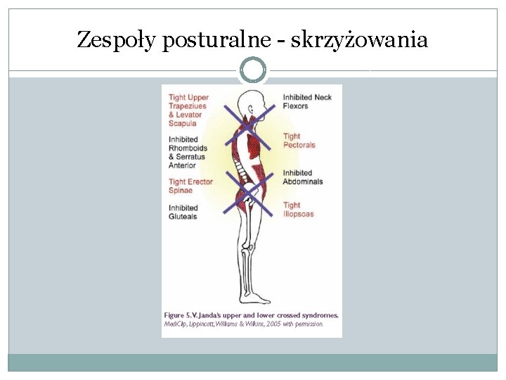 Zespoły posturalne - skrzyżowania 