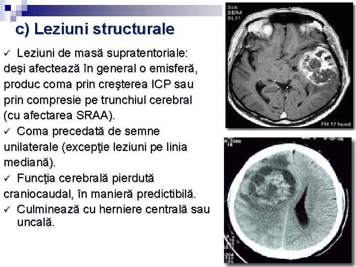 c) Leziuni structurale Leziuni de masă supratentoriale: deşi afectează în general o emisferă, produc c) Leziuni structurale Leziuni de masă supratentoriale: deşi afectează în general o emisferă, produc