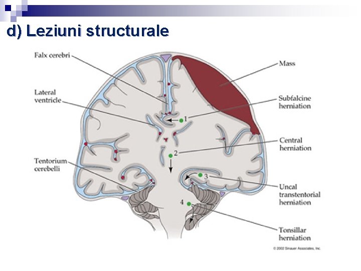 d) Leziuni structurale d) Leziuni structurale