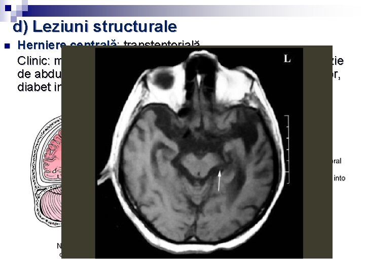 d) Leziuni structurale n Herniere centrală: transtentorială. Clinic: mioză, postură de decorticare→decerebrare, paralizie de d) Leziuni structurale n Herniere centrală: transtentorială. Clinic: mioză, postură de decorticare→decerebrare, paralizie de