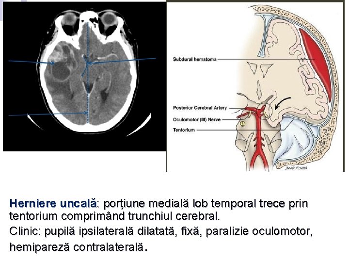 d) Leziuni structurale Herniere uncală: porţiune medială lob temporal trece prin tentorium comprimând trunchiul d) Leziuni structurale Herniere uncală: porţiune medială lob temporal trece prin tentorium comprimând trunchiul