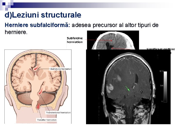 d)Leziuni structurale Herniere subfalciformă: adesea precursor al altor tipuri de herniere. d)Leziuni structurale Herniere subfalciformă: adesea precursor al altor tipuri de herniere.