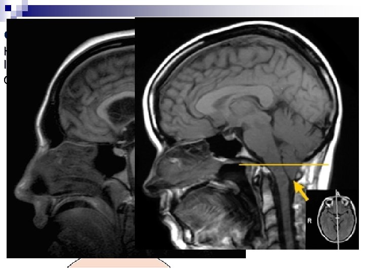 d) Leziuni structurale Herniere cerebeloasă ( ȋn sus, transtentorial) sau tonsilară: leziune infratentorială( AVC d) Leziuni structurale Herniere cerebeloasă ( ȋn sus, transtentorial) sau tonsilară: leziune infratentorială( AVC