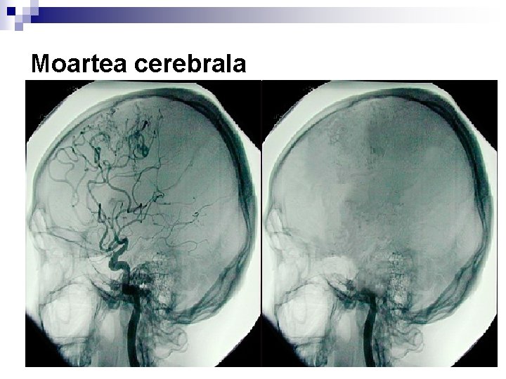 Moartea cerebrala n Încetare funcţii trunchi cerebral: -abolire reflex fotomotor -reflex corneean absent -reflex Moartea cerebrala n Încetare funcţii trunchi cerebral: -abolire reflex fotomotor -reflex corneean absent -reflex
