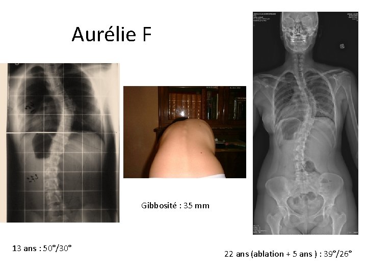 Aurélie Frizot Gibbosité : 35 mm 13 ans : 50°/30° 22 ans (ablation + Aurélie Frizot Gibbosité : 35 mm 13 ans : 50°/30° 22 ans (ablation +