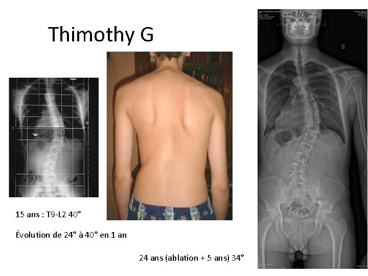 Thimothy Garnier 15 ans : T 9 -L 2 40° Évolution de 24° à Thimothy Garnier 15 ans : T 9 -L 2 40° Évolution de 24° à