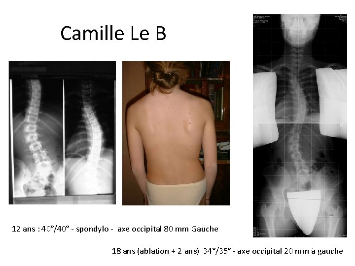 Camille Le Bihan 12 ans : 40°/40° - spondylo - axe occipital 80 mm Camille Le Bihan 12 ans : 40°/40° - spondylo - axe occipital 80 mm
