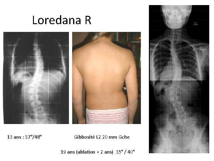 Loredana Rushiti 13 ans : 37°/48° Gibbosité L 2 20 mm Gche 19 ans Loredana Rushiti 13 ans : 37°/48° Gibbosité L 2 20 mm Gche 19 ans