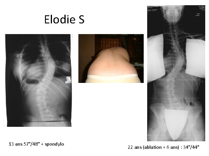 Elodie Sauze 13 ans 57°/48° + spondylo 22 ans (ablation + 6 ans) : Elodie Sauze 13 ans 57°/48° + spondylo 22 ans (ablation + 6 ans) :