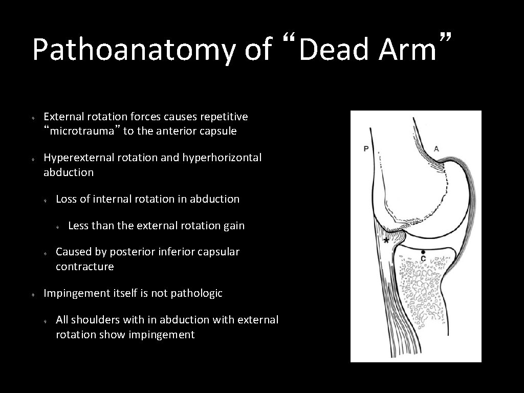 Pathoanatomy of “Dead Arm” External rotation forces causes repetitive “microtrauma” to the anterior capsule