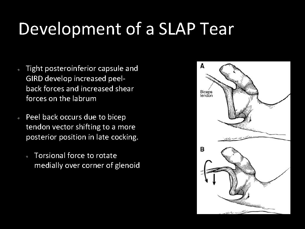 Development of a SLAP Tear Tight posteroinferior capsule and GIRD develop increased peelback forces