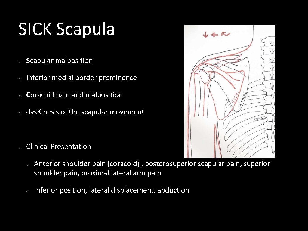 SICK Scapular malposition Inferior medial border prominence Coracoid pain and malposition dys. Kinesis of