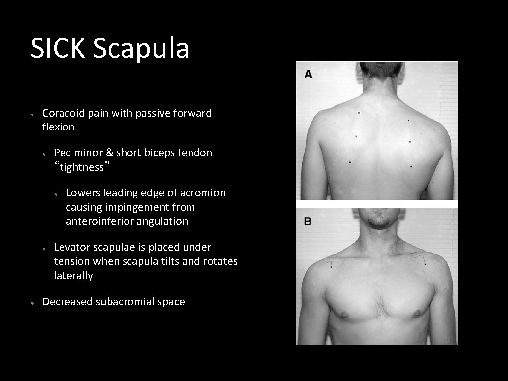 SICK Scapula Coracoid pain with passive forward flexion Pec minor & short biceps tendon
