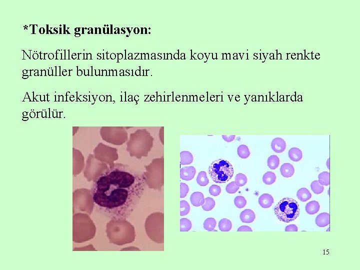 *Toksik granülasyon: Nötrofillerin sitoplazmasında koyu mavi siyah renkte granüller bulunmasıdır. Akut infeksiyon, ilaç zehirlenmeleri