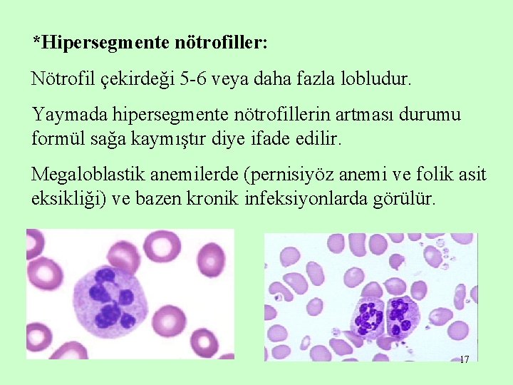 *Hipersegmente nötrofiller: Nötrofil çekirdeği 5 -6 veya daha fazla lobludur. Yaymada hipersegmente nötrofillerin artması