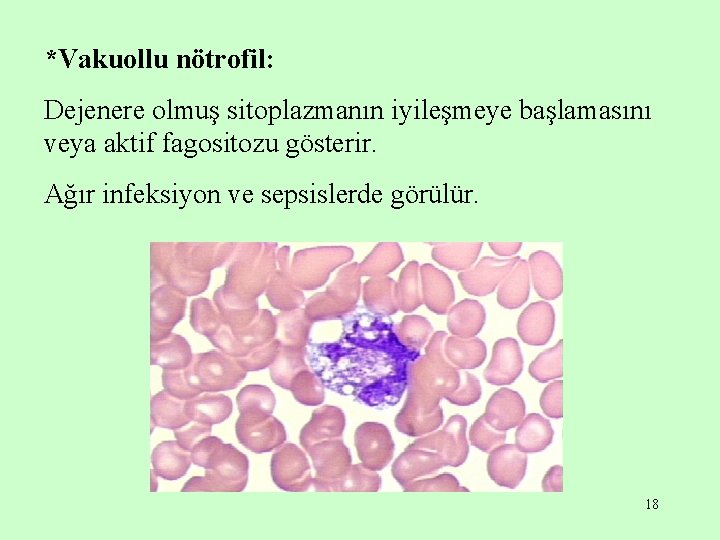 *Vakuollu nötrofil: Dejenere olmuş sitoplazmanın iyileşmeye başlamasını veya aktif fagositozu gösterir. Ağır infeksiyon ve