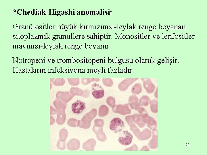 *Chediak-Higashi anomalisi: Granülositler büyük kırmızımsı-leylak renge boyanan sitoplazmik granüllere sahiptir. Monositler ve lenfositler mavimsi-leylak