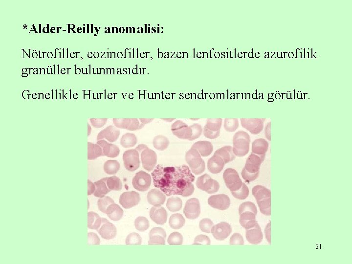 *Alder-Reilly anomalisi: Nötrofiller, eozinofiller, bazen lenfositlerde azurofilik granüller bulunmasıdır. Genellikle Hurler ve Hunter sendromlarında