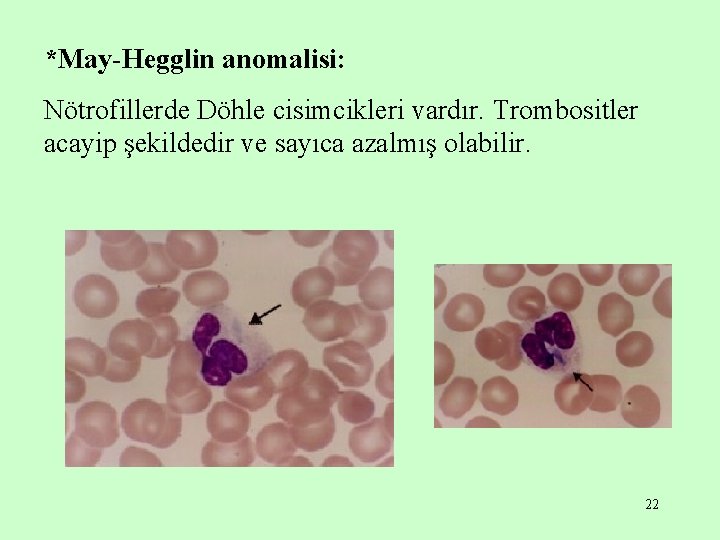 *May-Hegglin anomalisi: Nötrofillerde Döhle cisimcikleri vardır. Trombositler acayip şekildedir ve sayıca azalmış olabilir. 22