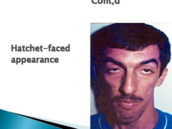 Cont, d Hatchet-faced appearance Cont, d Hatchet-faced appearance