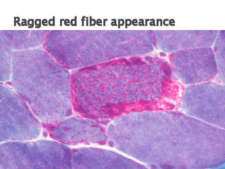 Ragged red fiber appearance courtesy : Prof. Janzer Ragged red fiber appearance courtesy : Prof. Janzer