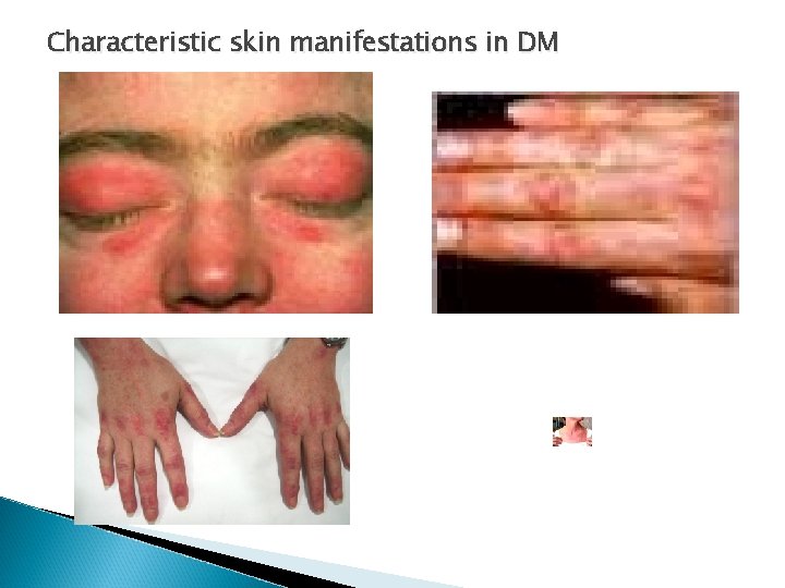Characteristic skin manifestations in DM Characteristic skin manifestations in DM