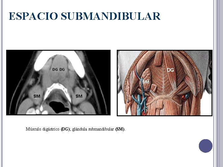 ESPACIO SUBMANDIBULAR DG DG DG SM SM SM Músculo digástrico (DG); glándula submandibular (SM).