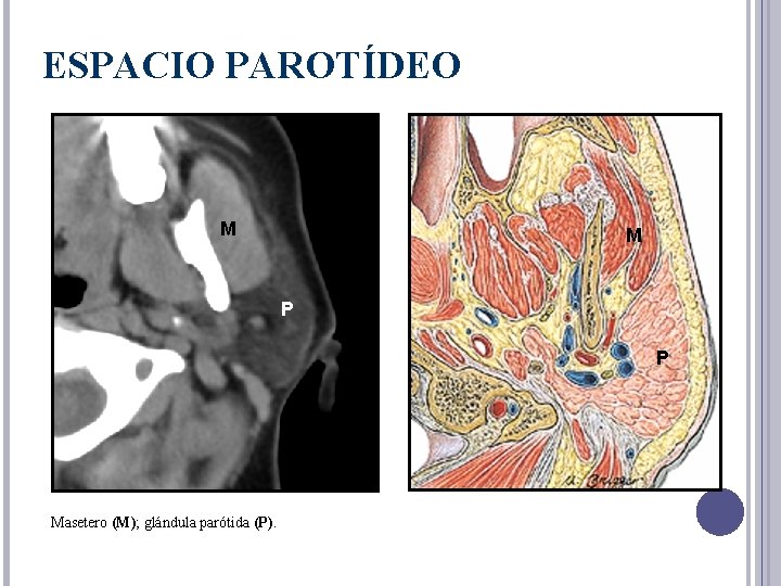 ESPACIO PAROTÍDEO M M P P Masetero (M); glándula parótida (P). 