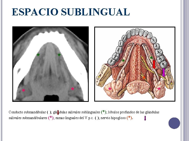 ESPACIO SUBLINGUAL * * * * * Conducto submandibular ( ); glándulas salivales sublinguales