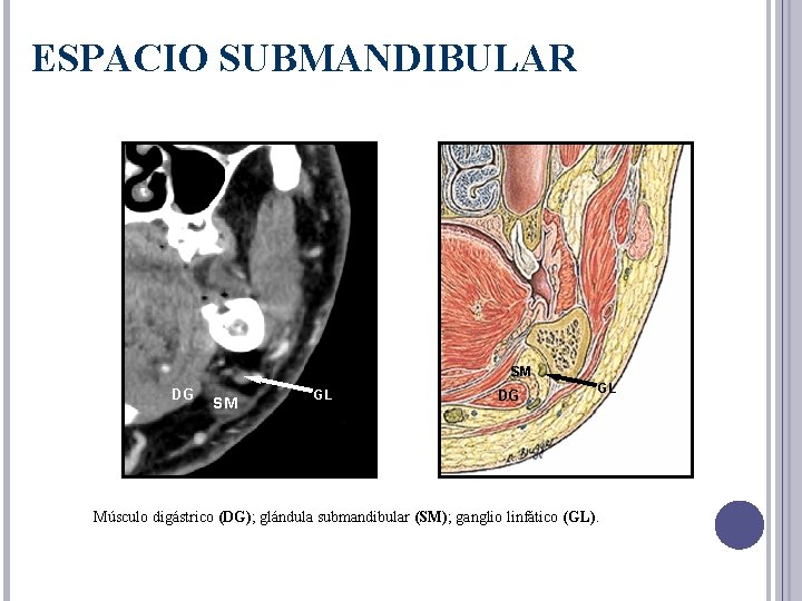 ESPACIO SUBMANDIBULAR SM DG SM GL DG GL Músculo digástrico (DG); glándula submandibular (SM);