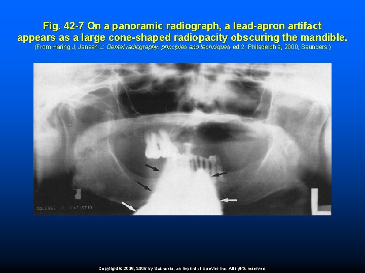 Fig. 42 -7 On a panoramic radiograph, a lead-apron artifact appears as a large