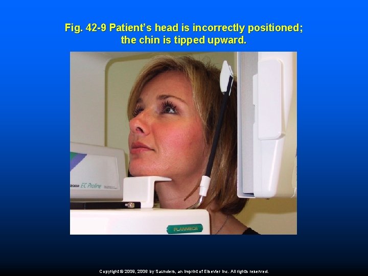 Fig. 42 -9 Patient’s head is incorrectly positioned; the chin is tipped upward. Copyright