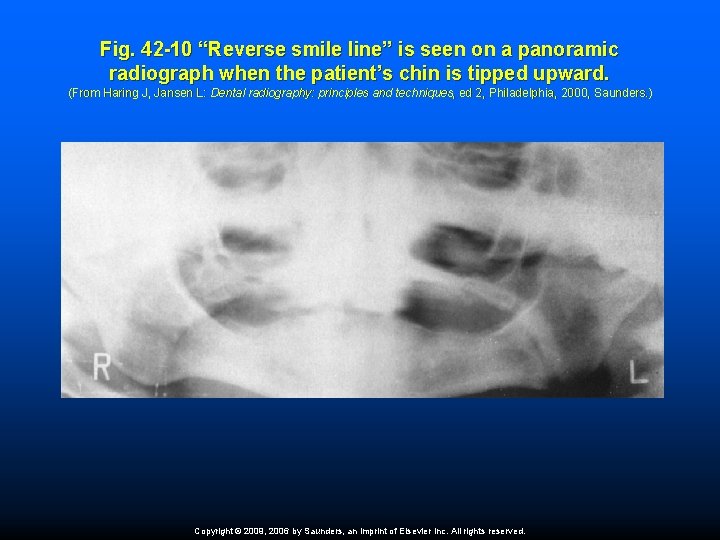 Fig. 42 -10 “Reverse smile line” is seen on a panoramic radiograph when the