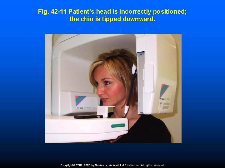 Fig. 42 -11 Patient’s head is incorrectly positioned; the chin is tipped downward. Copyright