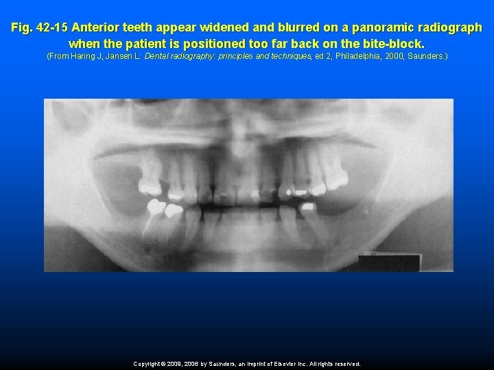 Fig. 42 -15 Anterior teeth appear widened and blurred on a panoramic radiograph when