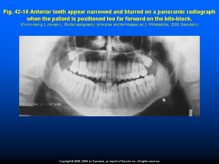 Fig. 42 -16 Anterior teeth appear narrowed and blurred on a panoramic radiograph when