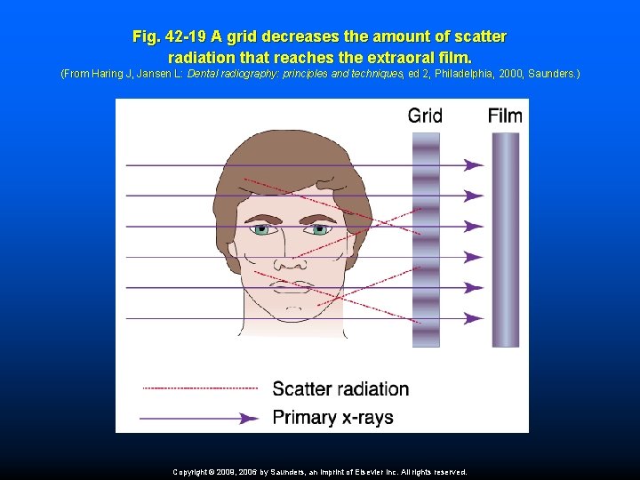 Fig. 42 -19 A grid decreases the amount of scatter radiation that reaches the