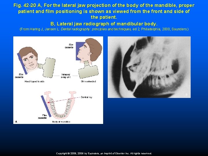 Fig. 42 -20 A, For the lateral jaw projection of the body of the