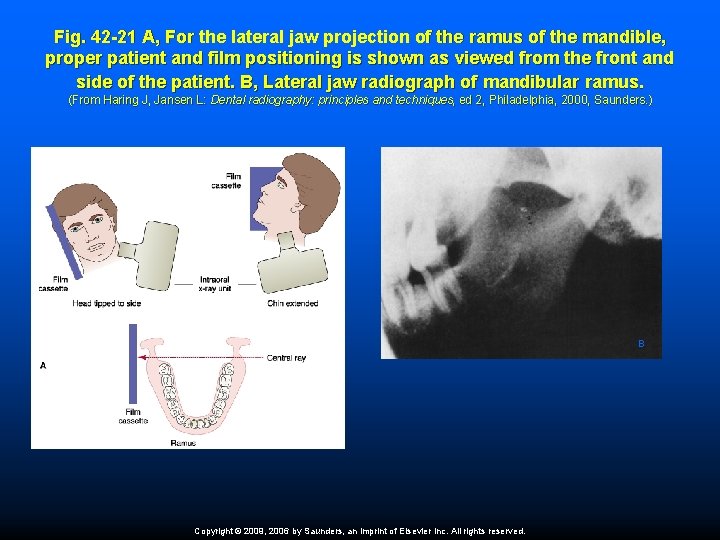 Fig. 42 -21 A, For the lateral jaw projection of the ramus of the