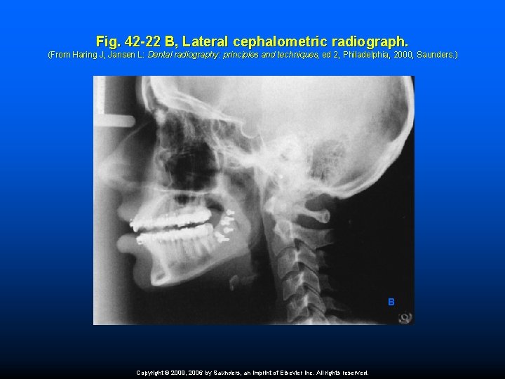 Fig. 42 -22 B, Lateral cephalometric radiograph. (From Haring J, Jansen L: Dental radiography: