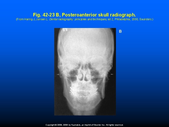 Fig. 42 -23 B, Posteroanterior skull radiograph. (From Haring J, Jansen L: Dental radiography:
