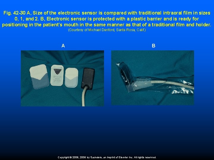 Fig. 42 -30 A, Size of the electronic sensor is compared with traditional intraoral