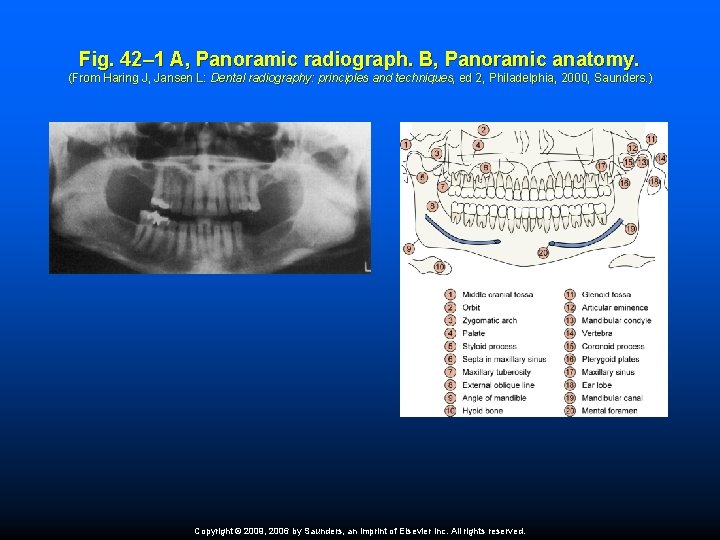 Fig. 42– 1 A, Panoramic radiograph. B, Panoramic anatomy. (From Haring J, Jansen L: