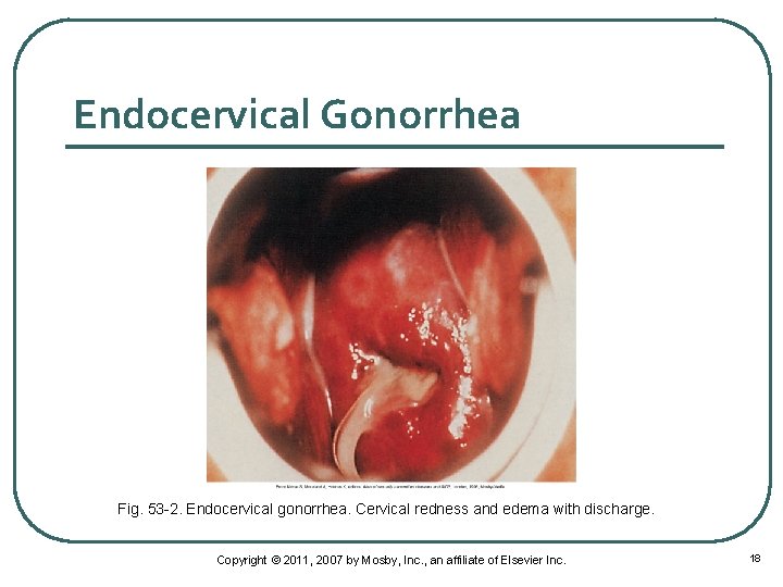 Endocervical Gonorrhea Fig. 53 -2. Endocervical gonorrhea. Cervical redness and edema with discharge. Copyright