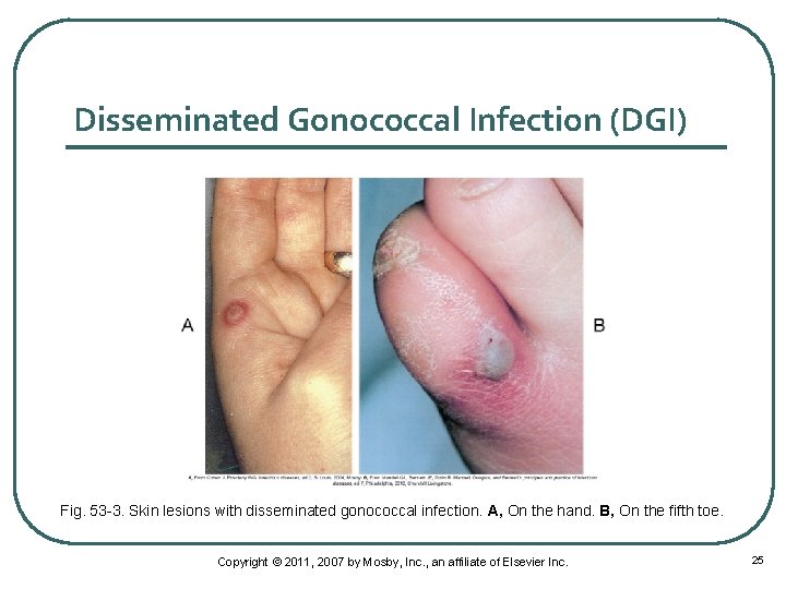 Disseminated Gonococcal Infection (DGI) Fig. 53 -3. Skin lesions with disseminated gonococcal infection. A,